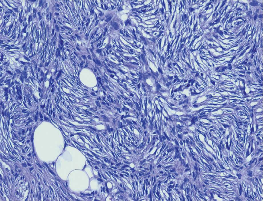 Células madre mesenquimatosas endometriales aisladas de la lesión menstrual reparada con epirubicina en las células de la granulosa ovárica humana mediante la inhibición de la expresión de Gadd45b en la vía del ciclo celular